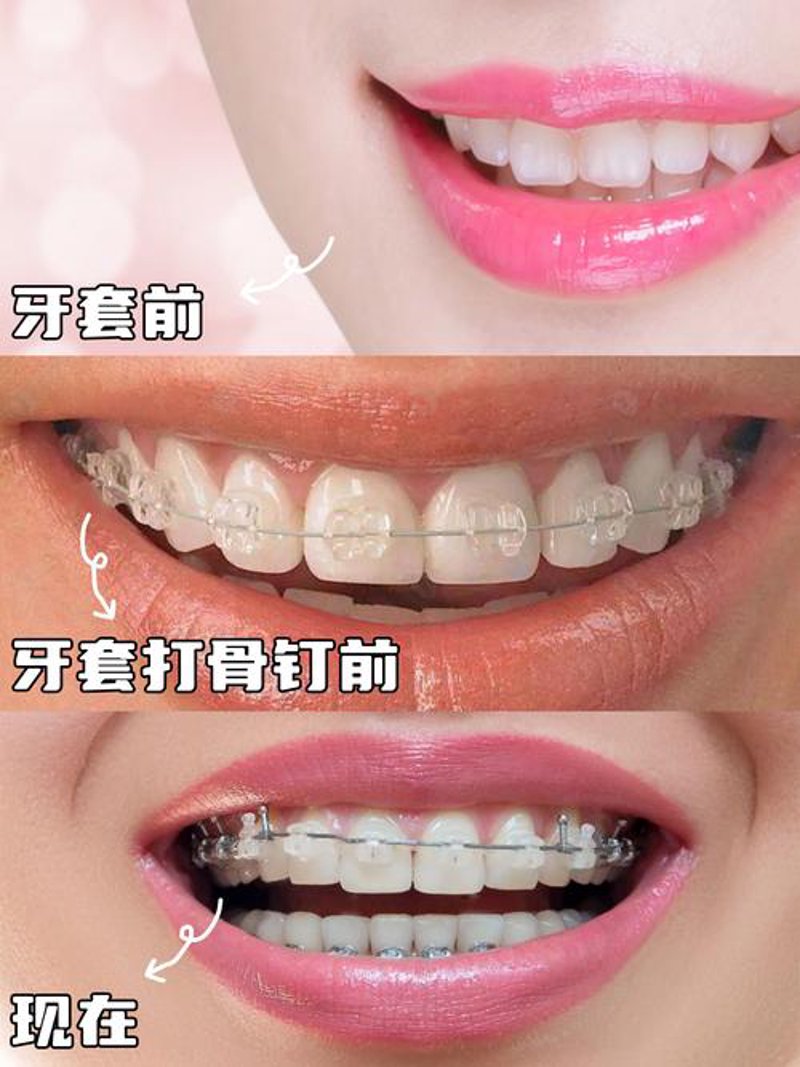 烤瓷牙